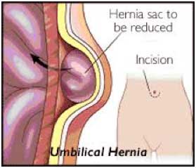 Umbilical hernia repair (child)