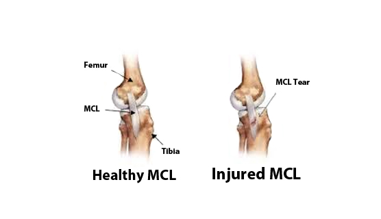MCL Tear, Orthopaedic Knee Surgeons