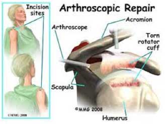 Arthroscopic rotator cuff repair - Mayo Clinic