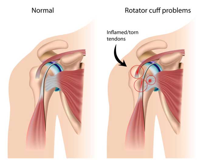 SHOULDER REPLACEMENT SURGERY TO FIX A ROTATOR CUFF TEAR - IS IT REQUIRED?