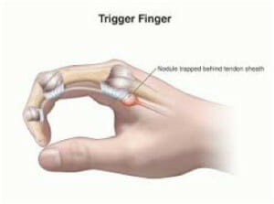 Trigger finger surgery in Utah