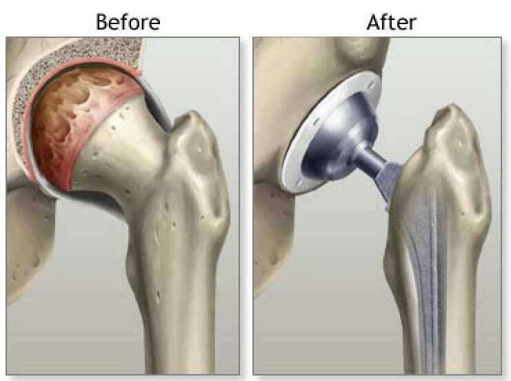 Anterior Approach Total Hip Replacement (AA-THR) - St. George Surgical  Center